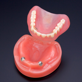 磁性アタッチメント義歯（磁石の力で固定する入れ歯）